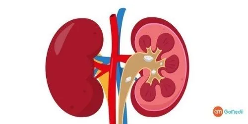 Kidney Treatment in India
