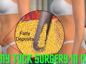 Tummy Tuck Surgery in India | EdhaCare